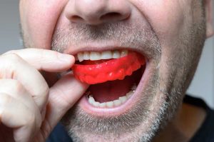 Mouthguard — General Cosmetic Dentistry In Caloundra, QLD