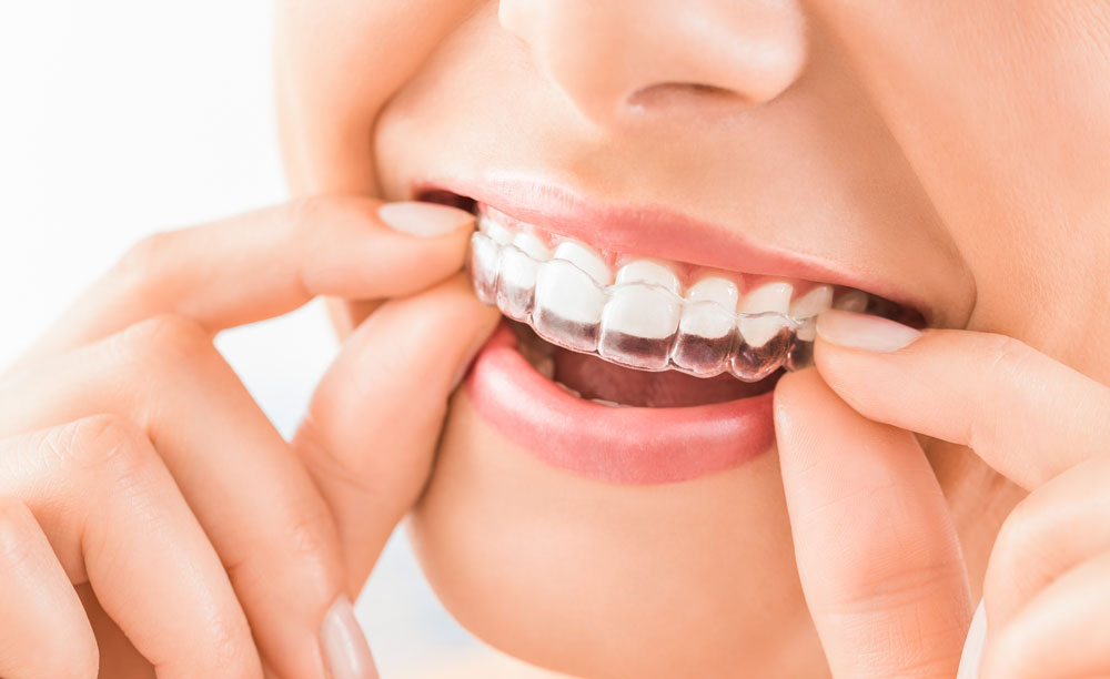 Orthodontics — General Cosmetic Dentistry In Caloundra, QLD